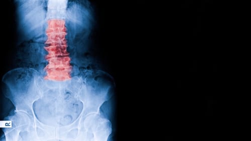 Las lesiones medulares pueden variar en niveles de gravedad